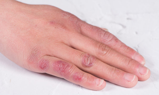 κρυοπαγήματα