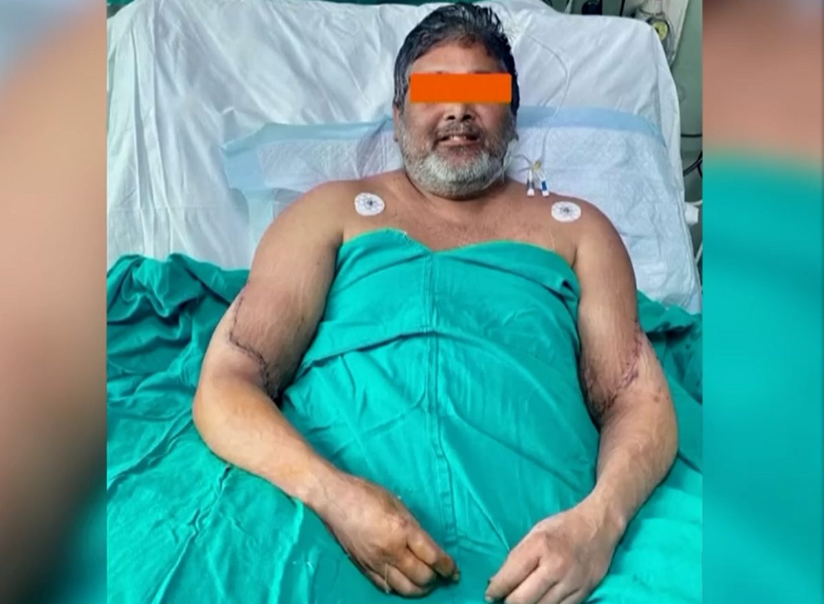 μεταμόσχευση