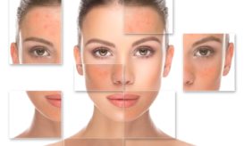 σημάδια ακμής