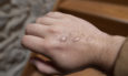 mpox, σημάδια στο χέρι