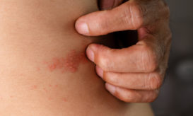 έρπης ζωστήρ