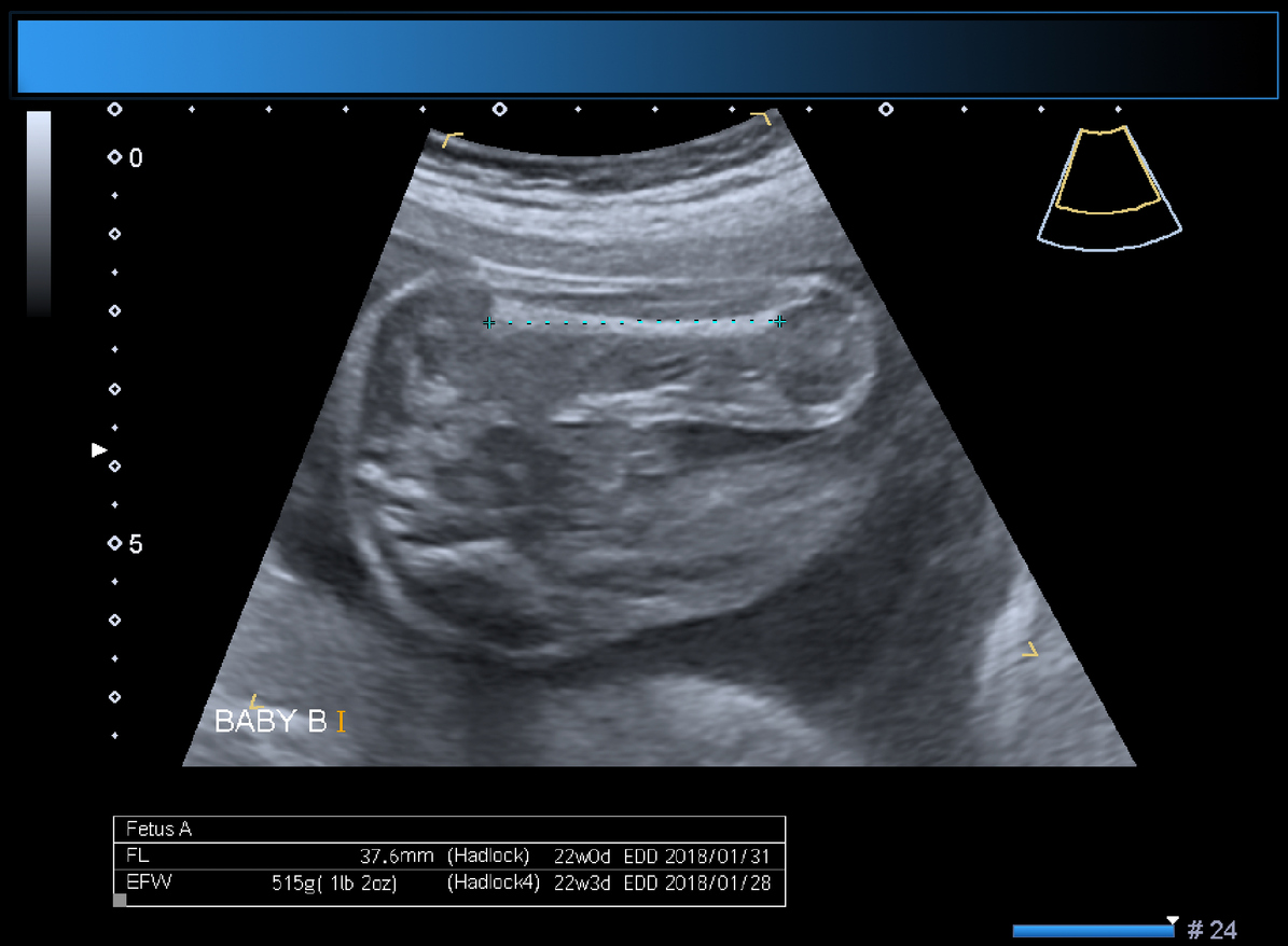 δίδυμη κύηση