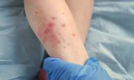 ιλαρά, παιδί