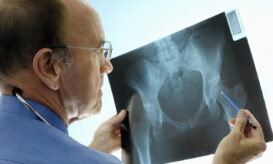 Οστεοπόρωση: Από ποια ηλικία ξεκινά, πού οφείλεται και πώς μπορείτε να προστατευθείτε