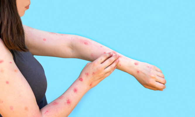 mpox