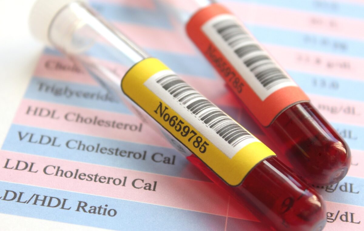 χοληστερόλη