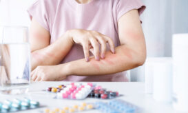 αναφυλαξία