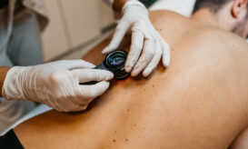 Καρκίνος του δέρματος: Ποιος πρέπει να ελέγχεται για μελάνωμα και πώς