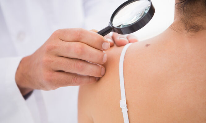 καρκίνος του δέρματος