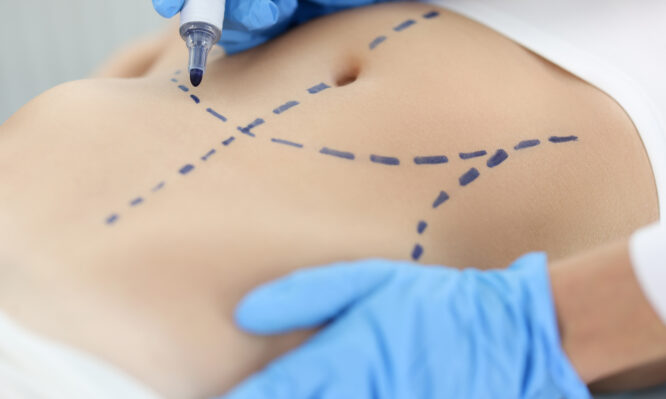 Βραζιλιάνα influencer πέθανε κατά τη διάρκεια λιποαναρρόφησης στην Τουρκία