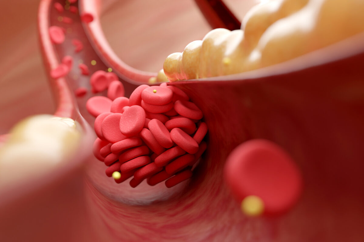 Συνδυασμός μεταλλάξεων αυξάνει τον κίνδυνο για θρόμβωση έως και 180%