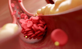 Συνδυασμός μεταλλάξεων αυξάνει τον κίνδυνο για θρόμβωση έως και 180%