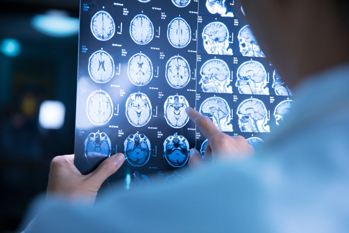 σκλήρυνση κατά πλάκας