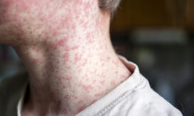 Ιλαρά: Σε επίπεδα ρεκόρ τα κρούσματα στις ΗΠΑ