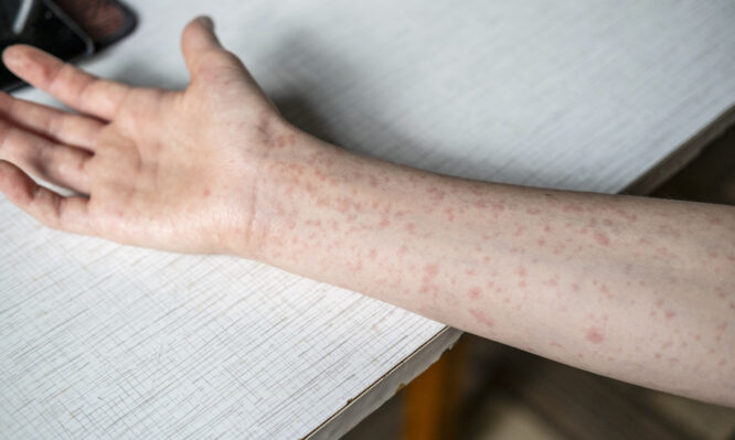 Άρχισαν τα μέτρα τύπου Covid για την ιλαρά