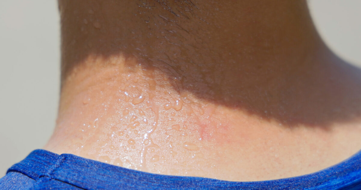 Ανιδρωσία: Τι πρέπει να γνωρίζετε για τη διαταραχή που οδήγησε στη θερμοπληξία τον 15χρονο στο Μέτσοβο