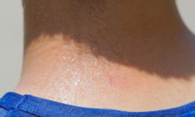 Ανιδρωσία: Τι πρέπει να γνωρίζετε για τη διαταραχή που οδήγησε στη θερμοπληξία τον 15χρονο στο Μέτσοβο