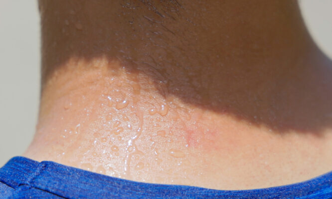 Ανιδρωσία: Τι πρέπει να γνωρίζετε για τη διαταραχή που οδήγησε στη θερμοπληξία τον 15χρονο στο Μέτσοβο