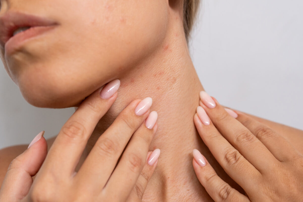 σπυράκια από τον ιδρώτα