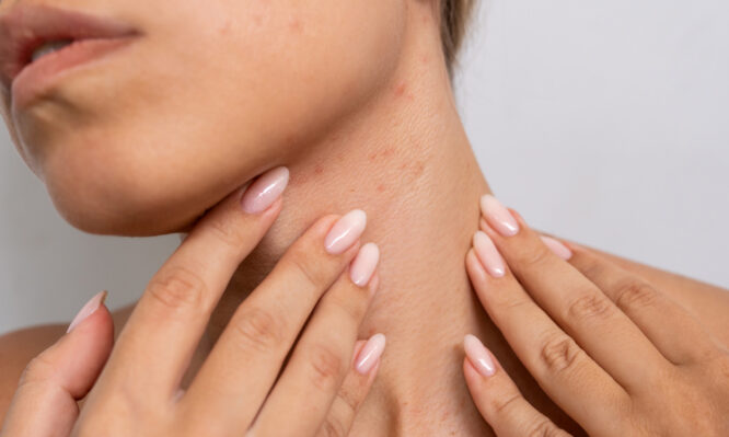 σπυράκια από τον ιδρώτα