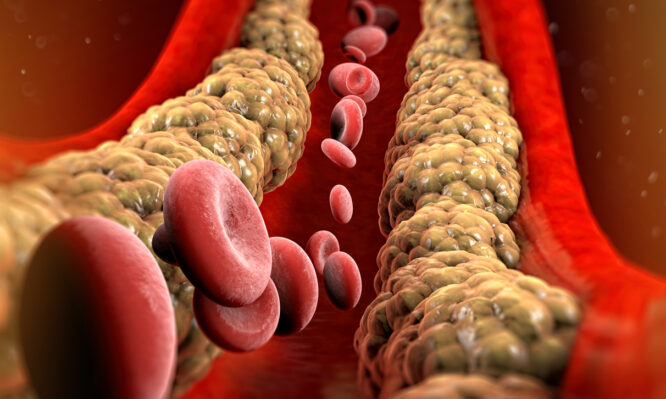 Χοληστερίνη: Με ελληνικό χρώμα οι αλλαγές στην αντιμετώπισή της πανευρωπαϊκά – Οι νέες συστάσεις