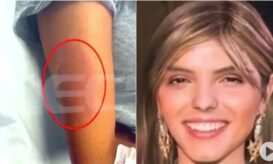 Μαρίσσα Λαιμού: Νέα φωτογραφία ντοκουμέντο με το πρησμένο χέρι από το μοιραίο τσίμπημα