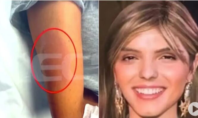 Μαρίσσα Λαιμού: Νέα φωτογραφία ντοκουμέντο με το πρησμένο χέρι από το μοιραίο τσίμπημα