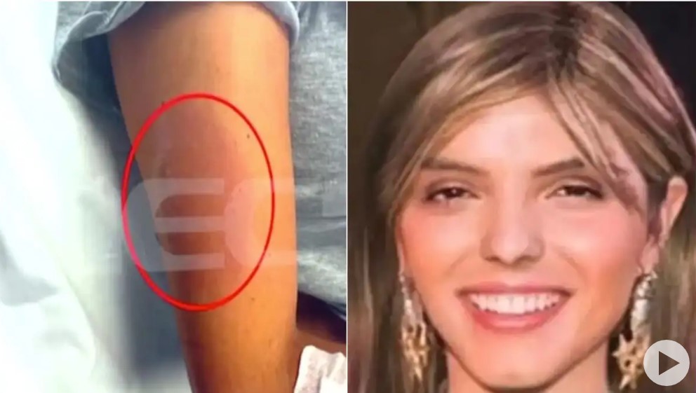 Μαρίσσα Λαιμού: Νέα φωτογραφία ντοκουμέντο με το πρησμένο χέρι από το μοιραίο τσίμπημα