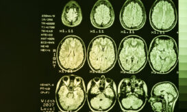 Νόσος του Χάντιγκτον: Επιστήμονες ενδέχεται να ανακάλυψαν την πρώτη γονιδιακή θεραπεία για την ανίατη εγκεφαλική νόσο