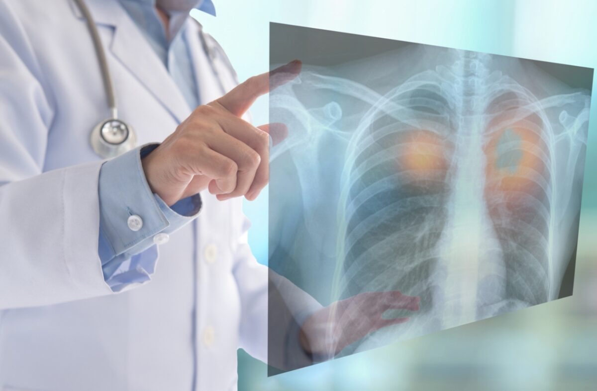 καρκίνος του πνεύμονα