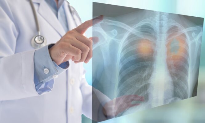 καρκίνος του πνεύμονα