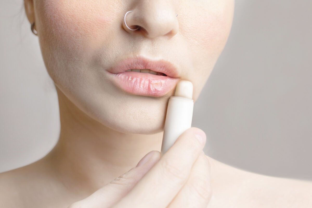 σκασμένα χείλη