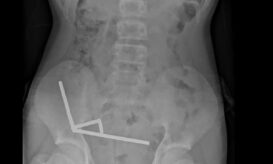 Γιατροί αφαίρεσαν 100 μαγνήτες από το έντερο 13χρονου αγοριού