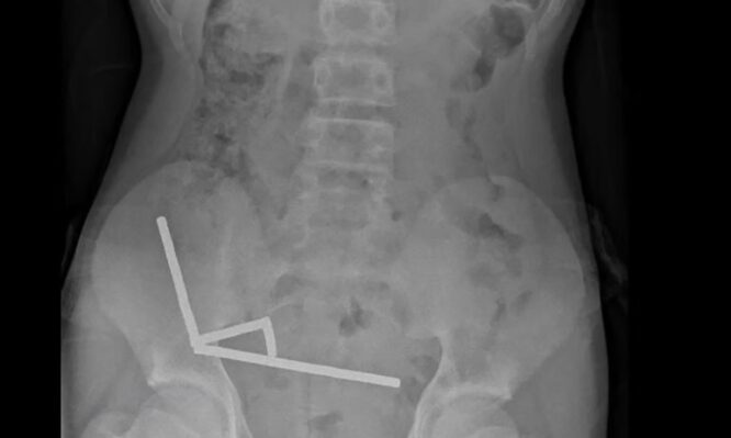 Γιατροί αφαίρεσαν 100 μαγνήτες από το έντερο 13χρονου αγοριού