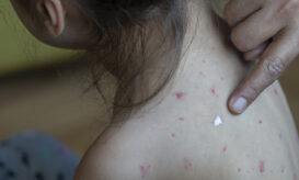 ΠΟΥ για ιλαρά: Τα κρούσματα παγκοσμίως μειώθηκαν κατά 71% σε 24 χρόνια χάρη στην εμβολιαστική κάλυψη