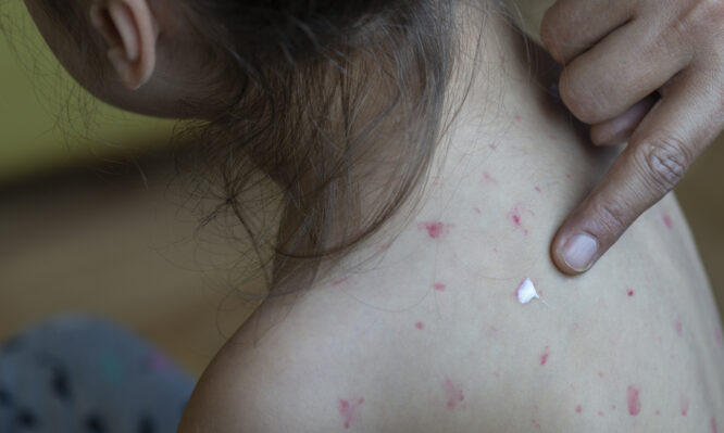 ΠΟΥ για ιλαρά: Τα κρούσματα παγκοσμίως μειώθηκαν κατά 71% σε 24 χρόνια χάρη στην εμβολιαστική κάλυψη