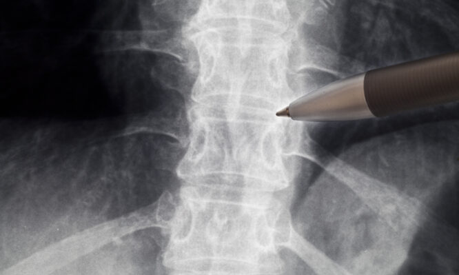 Επιστήμονες μετατρέπουν σωματικό λίπος σε οστά για να θεραπεύσουν κατάγματα της σπονδυλικής στήλης