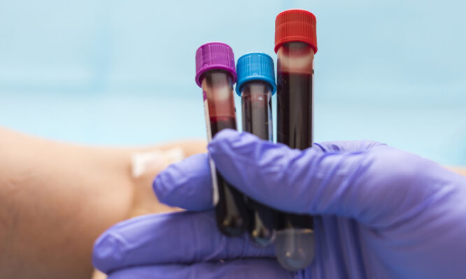 Εξέταση αίματος μπορεί να ανιχνεύσει νόσους 10 χρόνια πριν εμφανιστούν τα συμπτώματα