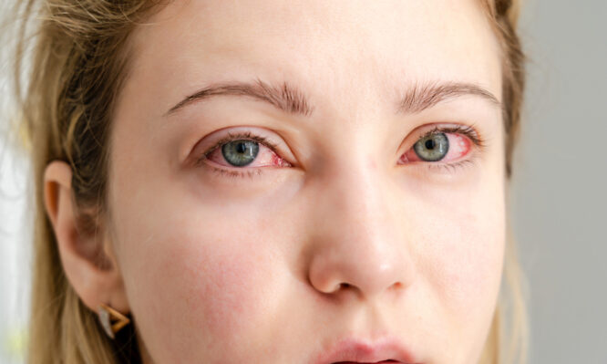 κόκκινα μάτια