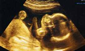 Γαλλία, έμβρυο