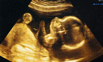 Γαλλία, έμβρυο