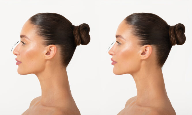 Ρινοπλαστική