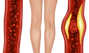 αρτηριοπάθεια