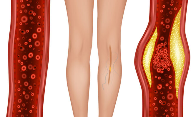 αρτηριοπάθεια