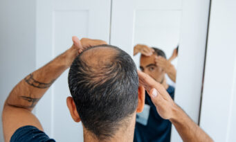 φαλάκρα - τριχόπτωση