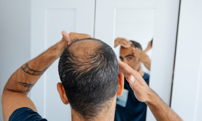 φαλάκρα - τριχόπτωση