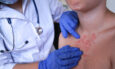mpox