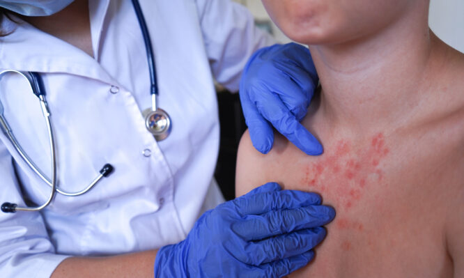 mpox